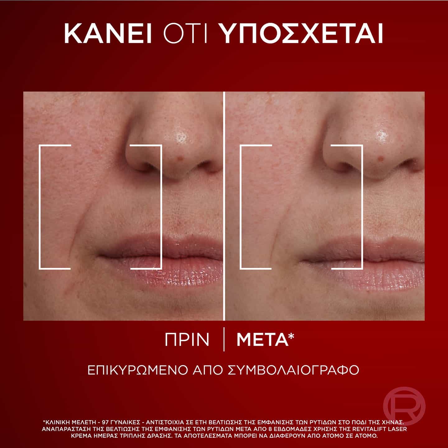 Laser Κρέμα Ημέρας Τριπλής Δράσης Πριν & Μετά